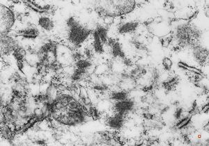 F,55y. | omentum - rhabdomyosarcoma